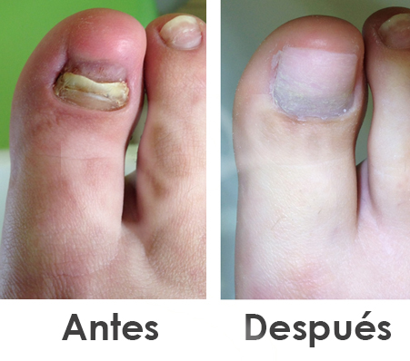 tratamiento para pie diabético